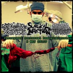 Wrong Illegal Abortion Procedure With Alarming Consequences : Paroxysmal Nocturnal Hemoglobinuria